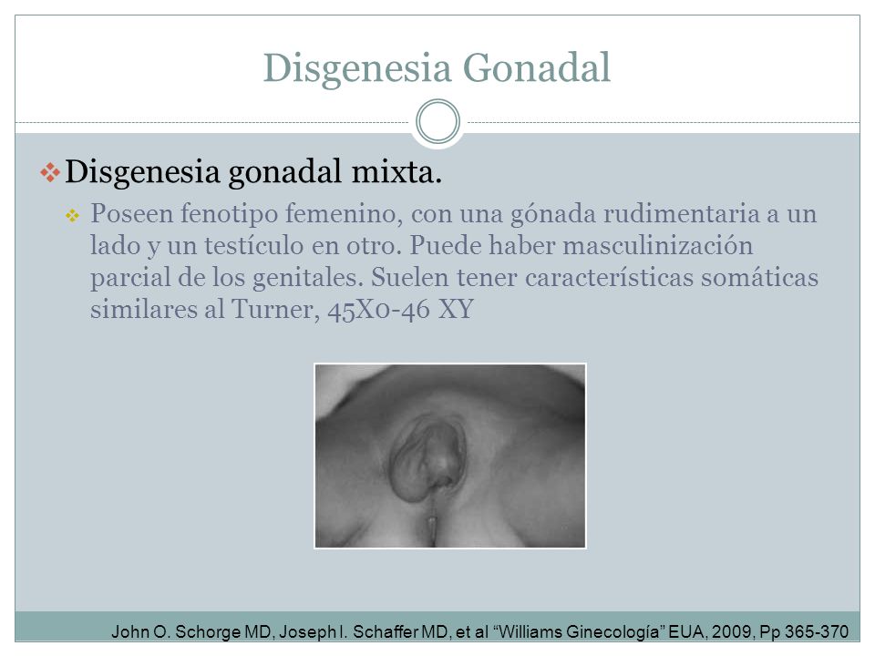 agenesia gonadal femenina